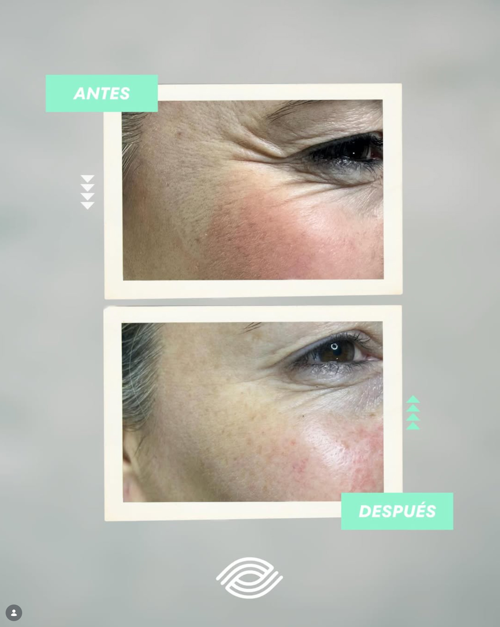 Comparativa antes y después en la zona de patas de gallo tras tratamiento estético realizado en Clínica Aleu.