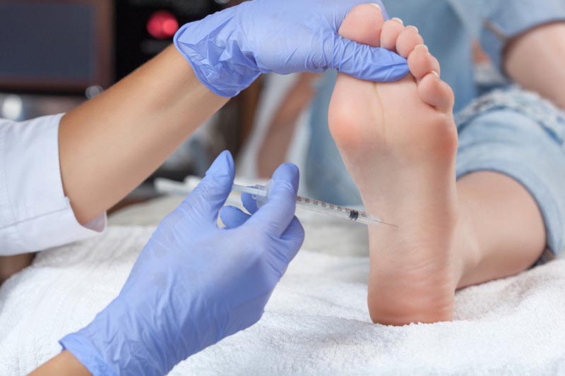 hiperhidrosis-plantar